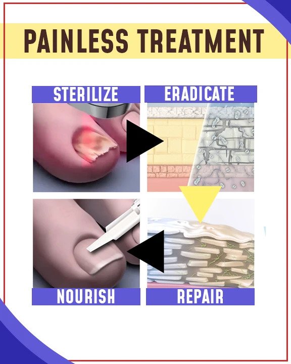 مجموعات العلاج بالضوء الأزرق المضادة للفطريات - Image 2