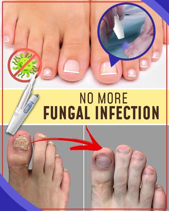 مجموعات العلاج بالضوء الأزرق المضادة للفطريات - Image 3