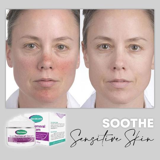 كريم ارتداد البشرة من ميديس - Image 6