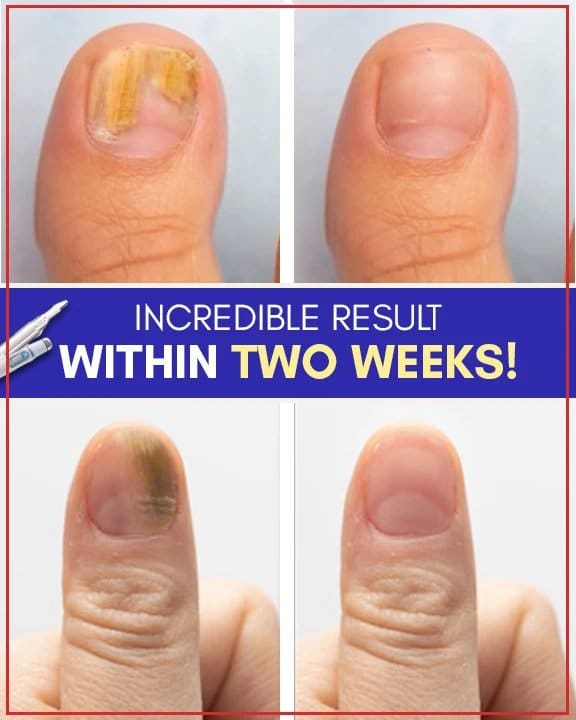 مجموعات العلاج بالضوء الأزرق المضادة للفطريات - Image 5