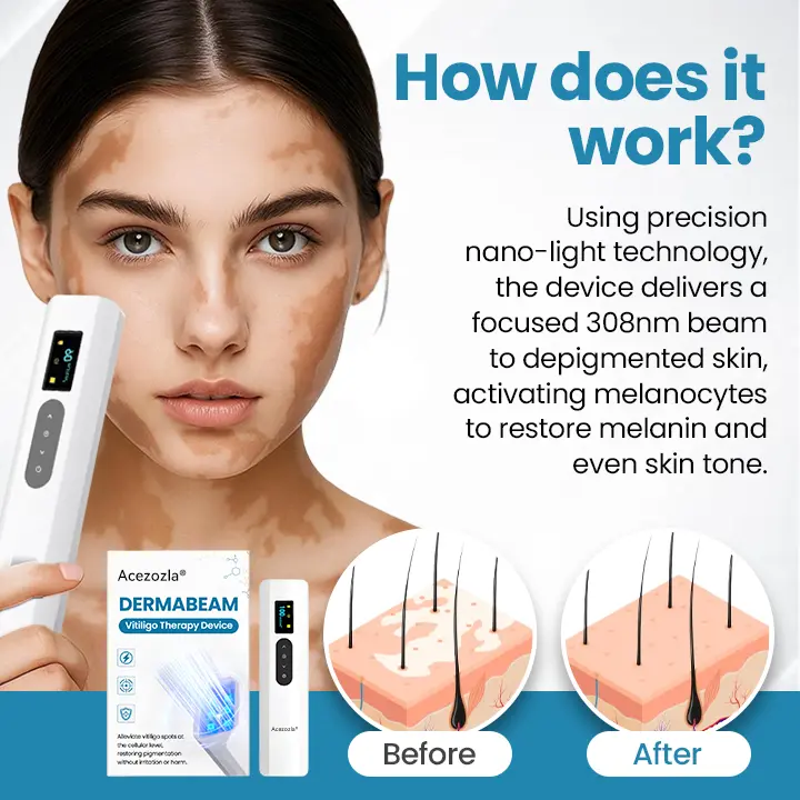 جهاز علاج البهاق Acezozla® DermaBeam - Image 3